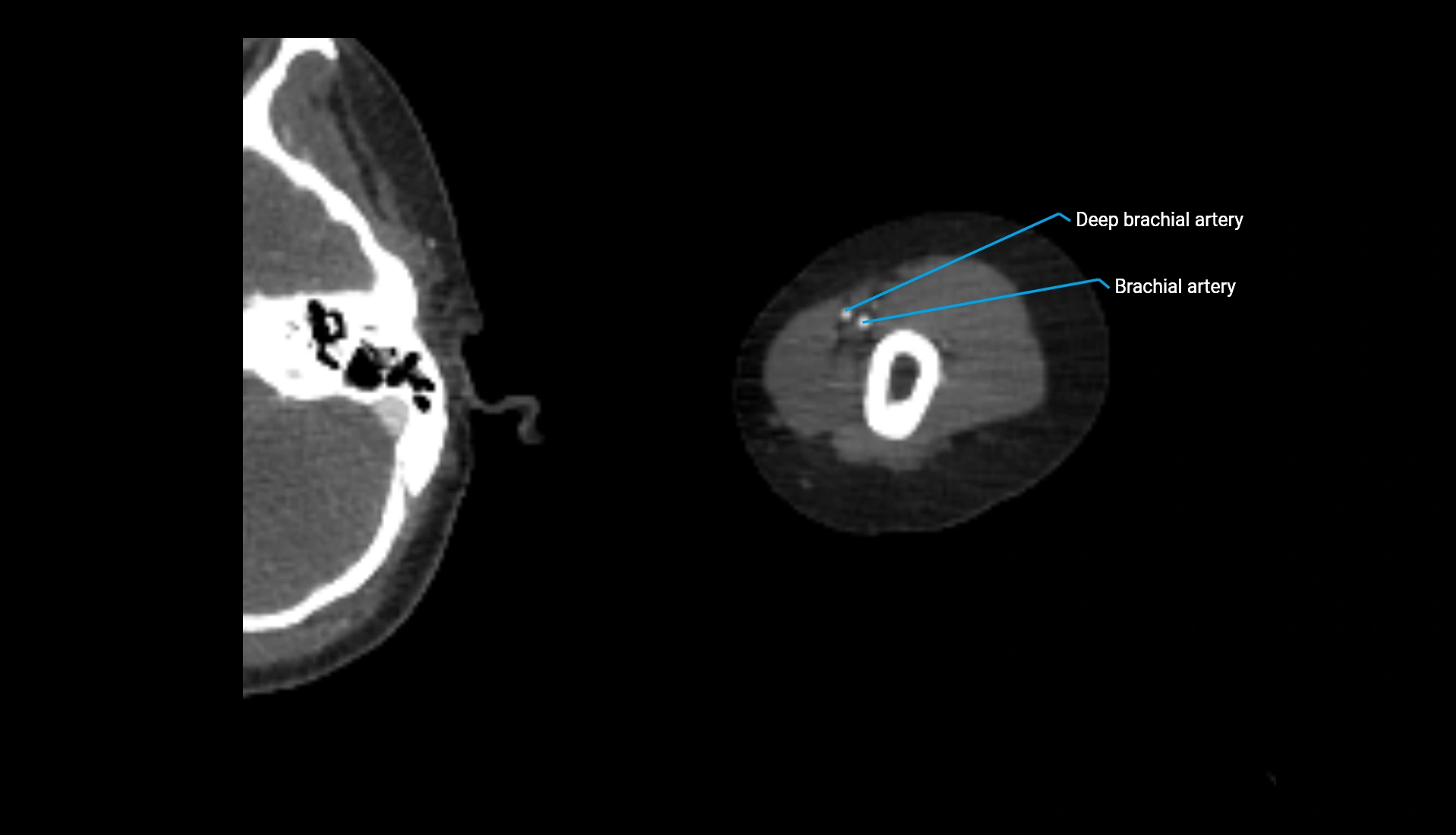 CTA upper limb axial cross sectional anatomy labelled image 262 (2).webp